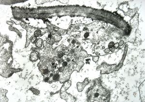 M,18y. | blood - clin. susp. leukemia - degraded Candida